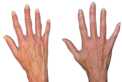 Effect of Neoveris for the treatment of varicose veins in hands