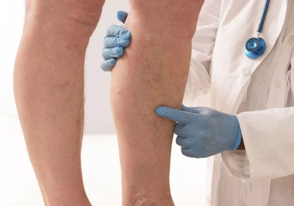 The treatment of varicose veins