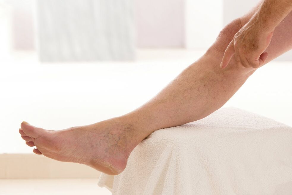 Varicosis veins in the legs