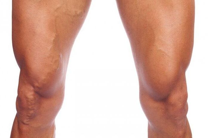 varicose veins
